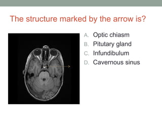 The structure marked by the arrow is?
A. Optic chiasm
B. Pitutary gland
C. Infundibulum
D. Cavernous sinus
 