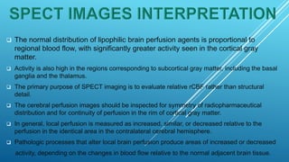 Brain perfusion nuclear medicine