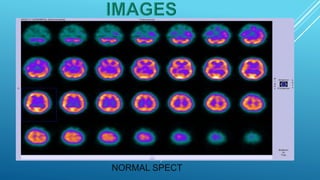 Brain perfusion nuclear medicine