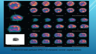 Brain perfusion nuclear medicine