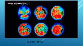 Brain perfusion nuclear medicine