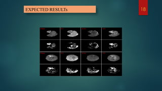 Brain tumor detection and segmentation using deep learning | PPTX