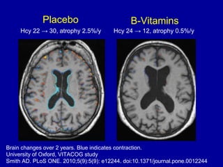 Placebo B-Vitamins
Hcy 22 → 30, atrophy 2.5%/y Hcy 24 → 12, atrophy 0.5%/y
Brain changes over 2 years. Blue indicates contraction.
University of Oxford, VITACOG study
Smith AD. PLoS ONE. 2010;5(9):5(9): e12244. doi:10.1371/journal.pone.0012244
 