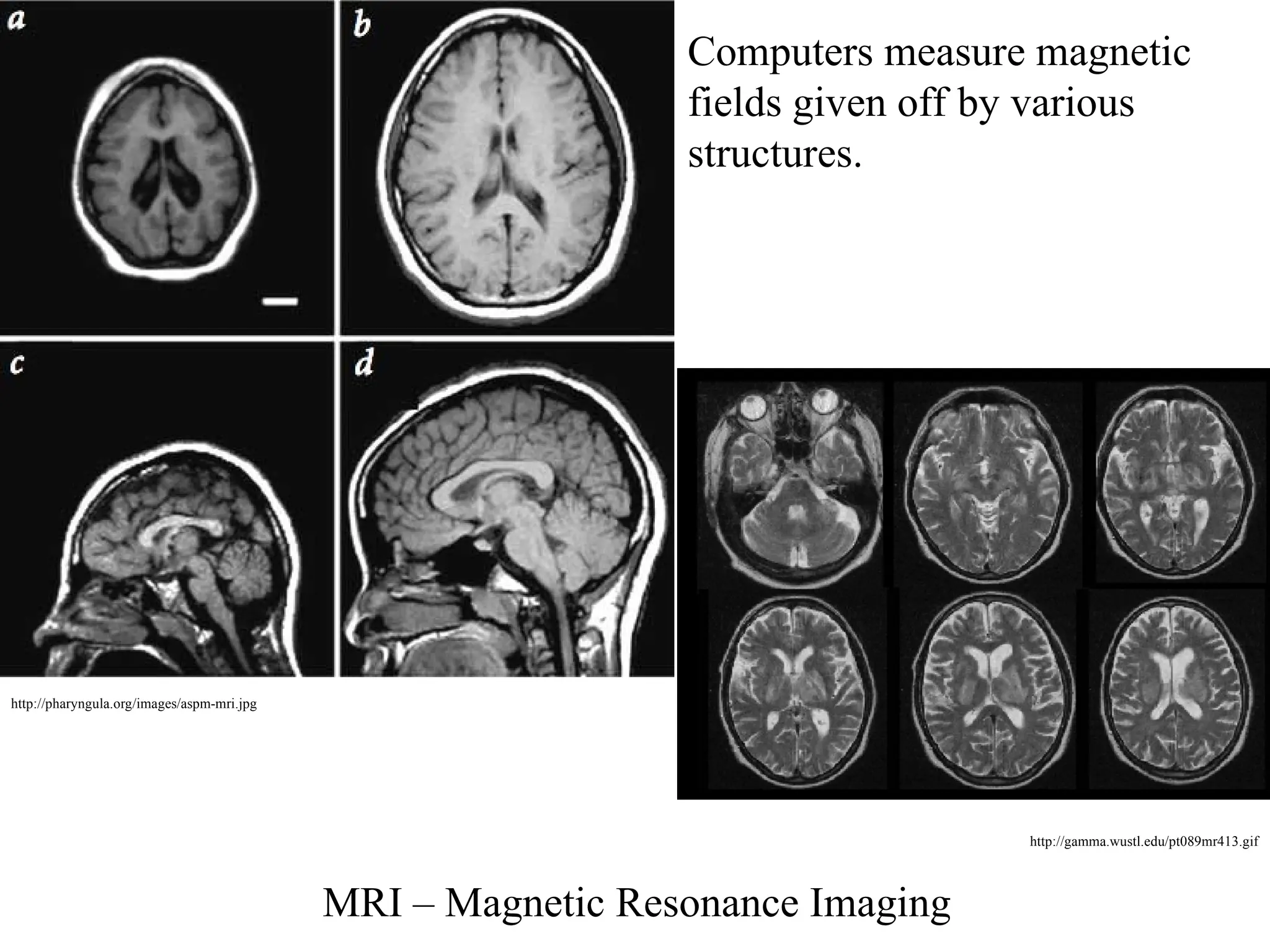 MRI – Magnetic Resonance Imaging
Computers measure magnetic
fields given off by various
structures.
http://pharyngula.org/images/aspm-mri.jpg
http://gamma.wustl.edu/pt089mr413.gif
 
