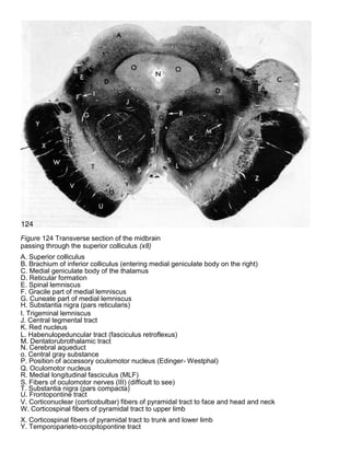 Figure 124 Transverse section of the midbrain
passing through the superior colliculus (x8)
A. Superior colliculus
B. Brachium of inferior colliculus (entering medial geniculate body on the right)
C. Medial geniculate body of the thalamus
D. Reticular formation
E. Spinal lemniscus
F. Gracile part of medial lemniscus
G. Cuneate part of medial lemniscus
H. Substantia nigra (pars reticularis)
I. Trigeminal lemniscus
J. Central tegmental tract
K. Red nucleus
L. Habenulopeduncular tract (fasciculus retroflexus)
M. Dentatorubrothalamic tract
N. Cerebral aqueduct
o. Central gray substance
P. Position of accessory oculomotor nucleus (Edinger- Westphal)
Q. Oculomotor nucleus
R. Medial longitudinal fasciculus (MLF)
S. Fibers of oculomotor nerves (III) (difficult to see)
T. Substantia nigra (pars compacta)
U. Frontopontine tract
V. Corticonuclear (corticobulbar) fibers of pyramidal tract to face and head and neck
W. Corticospinal fibers of pyramidal tract to upper limb
X. Corticospinal fibers of pyramidal tract to trunk and lower limb
Y. Temporoparieto-occipitopontine tract
 