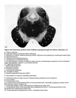 Figure 122 Transverse section of the midbrain passing through the inferior colliculus (x8)
A. Inferior colliculus
B. Lateral lemniscus (entering inferior colliculus)
C. Brachium of inferior colliculus (leaving inferior colliculus and projecting to medial geniculate body)
D. Spinal lemniscus
E. Gracile part of medial lemniscus
F. Cuneate part of medial lemniscus
G. Dorsal (posterior) nucleus of raphe (a major source of serotonergic projections to the substantia
nigra, diencephalon, striatum, and cerebral cortex)
H. Trigeminal lemniscus
I. Central tegmental tract
J. Reticular formation
K. Cerebral aqueduct
L. Central gray substance
M. Trochlear nucleus
N. Medial longitudinal fasciculus (MLF)
O. Decussation of superior cerebellar peduncles
P. Substantia nigra (a major source of dopaminergic projections to the striatum)
Q. Crus cerebri
R. Frontopontine tract
S. Corticonuclear (corticobulbar) fibers of the pyramidal tract, eventually supplying muscles of the
face, pharynx, larynx, tongue, etc.
T. Corticospinal fibers of the pyramidal tract supplying the upper limb
U. Corticospinal fibers of the pyramidal (tract supplying the trunk V. Corticospinal fibers of the
pyramidal tract supplying the lower limb
W. Temporoparieto-occipitopontine tract X. Interpeduncular fossa
 