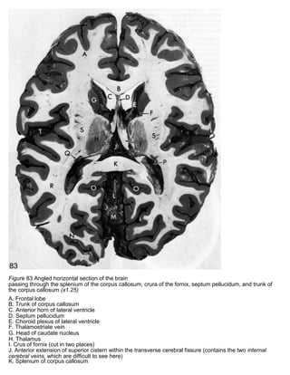 Figure 83 Angled horizontal section of the brain
passing through the splenium of the corpus callosum, crura of the fornix, septum pellucidum, and trunk of
the corpus callosum (x1.25)
A. Frontal lobe
B. Trunk of corpus callosum
C. Anterior horn of lateral ventricle
D. Septum pellucidum
E. Choroid plexus of lateral ventricle
F. Thalamostriate vein
G. Head of caudate nucleus
H. Thalamus
I. Crus of fornix (cut in two places)
J. Anterior extension of superior cistern within the transverse cerebral fissure (contains the two internal
cerebral veins, which are difficult to see here)
K. Splenium of corpus callosum
 