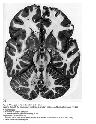 Figure 79 Angled horizontal section of the brain
passing through the cerebellum, midbrain, mamillary bodies, and lamina terminalis (x1.25)
A. Frontal lobe
B. Rostrum of corpus callosum
C. Anterior cerebral arteries (running in the
longitudinal cerebral fissure)
D. Lamina terminalis (cistern of the lamina terminalis is just anterior to this structure)
E. Third ventricle (inferior part)
 