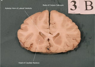 Brain sections - anatomy