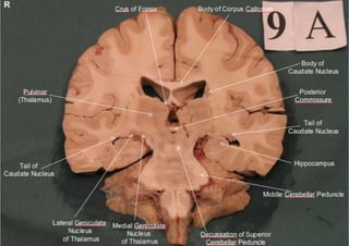 Brain sections - anatomy | PDF