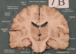 Brain sections - anatomy | PDF