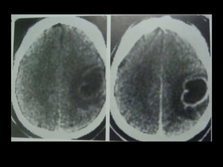 Radiology lecture of Brain space occupying lesions.ppt