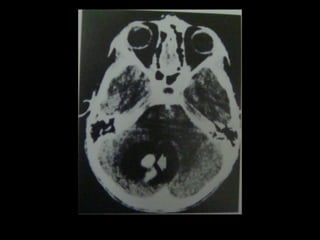 Radiology lecture of Brain space occupying lesions.ppt
