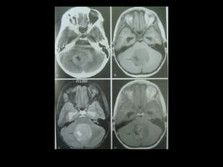 Radiology lecture of Brain space occupying lesions.ppt