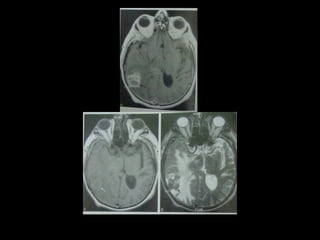 Radiology lecture of Brain space occupying lesions.ppt