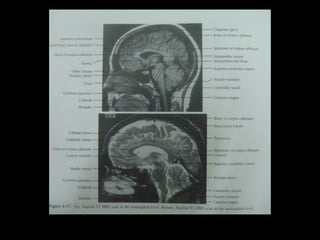 Radiology lecture of Brain space occupying lesions.ppt