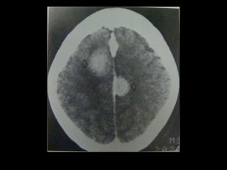 Radiology lecture of Brain space occupying lesions.ppt