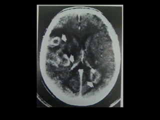 Radiology lecture of Brain space occupying lesions.ppt