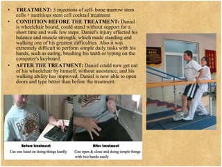 TREATMENT:  3 injections of self- bone marrow stem cells + nutritious stem cell cocktail treatment  CONDITION BEFORE THE TREATMENT:  Daniel is wheelchair bound, could stand without support for a short time and walk few steps. Daniel's injury effected his balance and muscle strength, which made standing and walking one of his greatest difficulties. Also it was extremely difficult to perform simple daily tasks with his hands, such as eating, brushing his teeth or typing on the computer's keyboard. AFTER THE TREATMENT:   Daniel could now get out of his wheelchair by himself, without assistance, and his walking ability has improved. Daniel is now able to open doors and type better than before the treatment.  