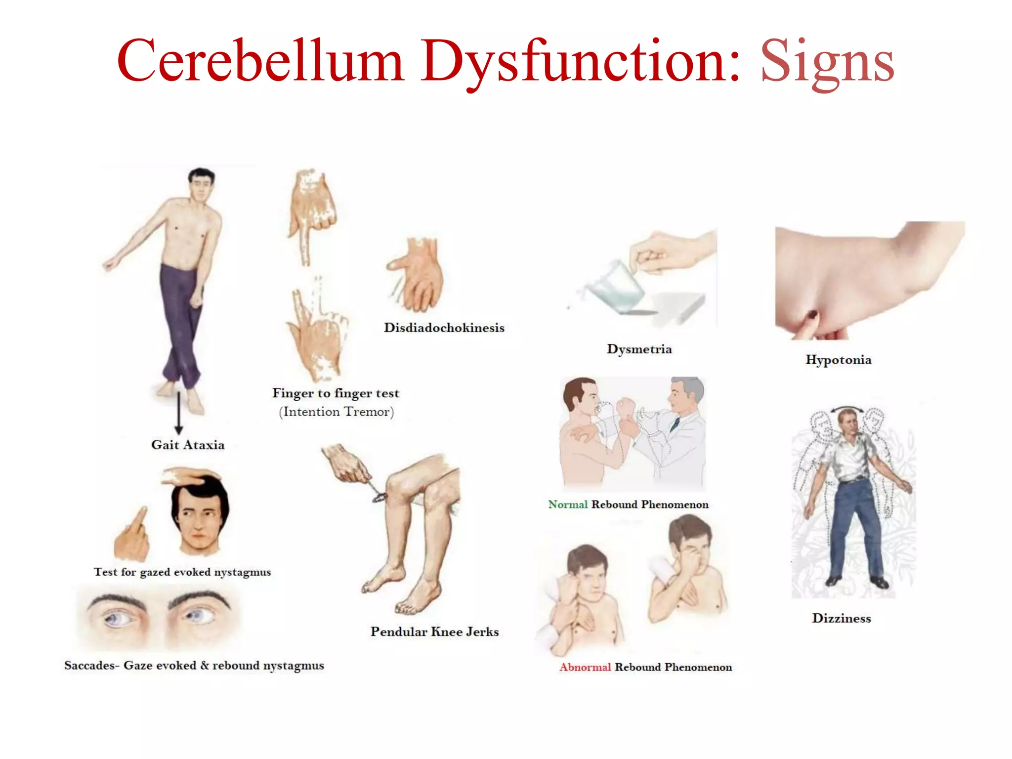 Cerebellum Dysfunction: Signs
 