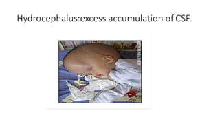 Hydrocephalus:excess accumulation of CSF.
 