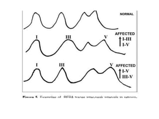 Brainstem auditory evoked responses (baer or abr | PPTX