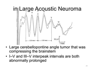 Brainstem auditory evoked responses (baer or abr | PPTX