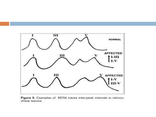 Brainstem auditory evoked responses (baer or abr | PPTX