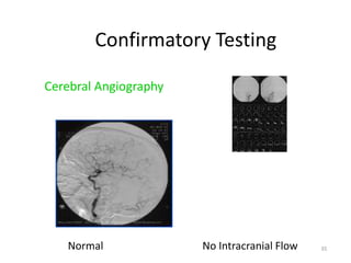 Confirmatory Testing
Cerebral Angiography
Normal No Intracranial Flow 35
 