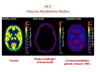 “Hollow-skull sign”
of brain death
Cerebral metabolism
globally reduced ~50%
Normal
PET
Glucose Metabolism Studies
37
 