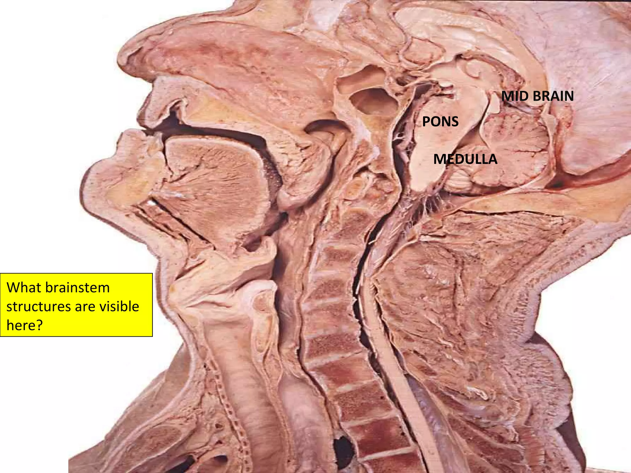 What brainstem structures are visible here? MID BRAIN PONS MEDULLA 