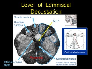 Level of Lemniscal
Decussation
Medial lemniscus
Carries 2nd order sensory
neurons to VPL thalamus
Gracile nucleus
Cuneate
nucleus
Internal arcuate
fibers
MLF
Pyramids
Position & vibration sense
 