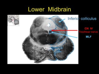 Lower Midbrain
Inferior colliculus
CN IV
Trochlear nerve
MLF
 