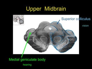 Upper Midbrain
Superior colliculus
vision
Medial geniculate body
hearing
 