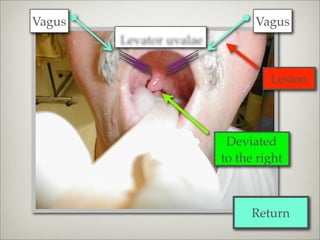 Vagus                          Vagus
        Levator uvalae


                                  Lesion



                          Deviated
                         to the right



                              Return
 