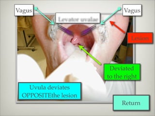 Vagus                              Vagus
            Levator uvalae


                                      Lesion



                              Deviated
                             to the right
   Uvula deviates
 OPPOSITEthe lesion
                                  Return
 