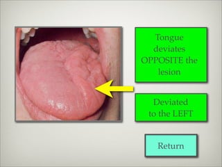 Tongue
  deviates
OPPOSITE the
   lesion


  Deviated
 to the LEFT


   Return
 