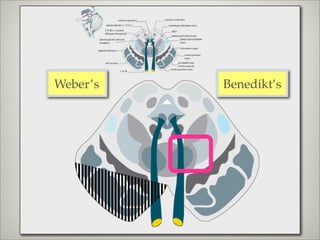 Weber’s   Benedikt’s
 