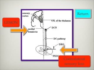 Return

LESION




         Contralateral
         sensory loss
 