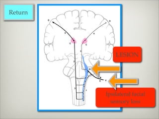 Return




             LESION




         Ipsilateral facial
           sensory loss
 