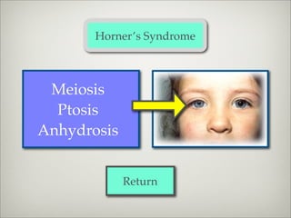 Horner’s Syndrome



 Meiosis
  Ptosis
Anhydrosis


             Return
 