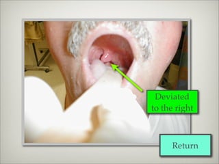 Deviated
to the right



     Return
 