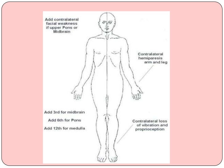 brain stem lesion symptoms Brain stem lessions in sensory symptoms brain stem lesion symptoms Brain stem lessions in sensory symptoms