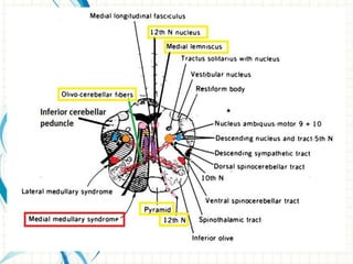 Medial Medullary Syndrome Ppt