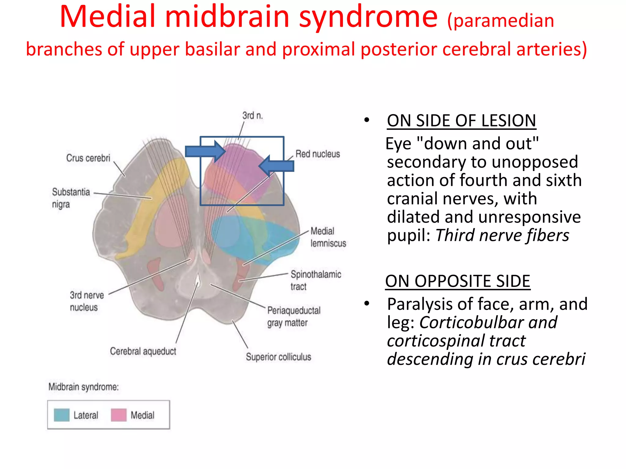 Medial midbrain syndrome (paramedian
branches of upper basilar and proximal posterior cerebral arteries)


                                        • ON SIDE OF LESION
                                          Eye "down and out"
                                          secondary to unopposed
                                          action of fourth and sixth
                                          cranial nerves, with
                                          dilated and unresponsive
                                          pupil: Third nerve fibers

                                          ON OPPOSITE SIDE
                                        • Paralysis of face, arm, and
                                          leg: Corticobulbar and
                                          corticospinal tract
                                          descending in crus cerebri
 