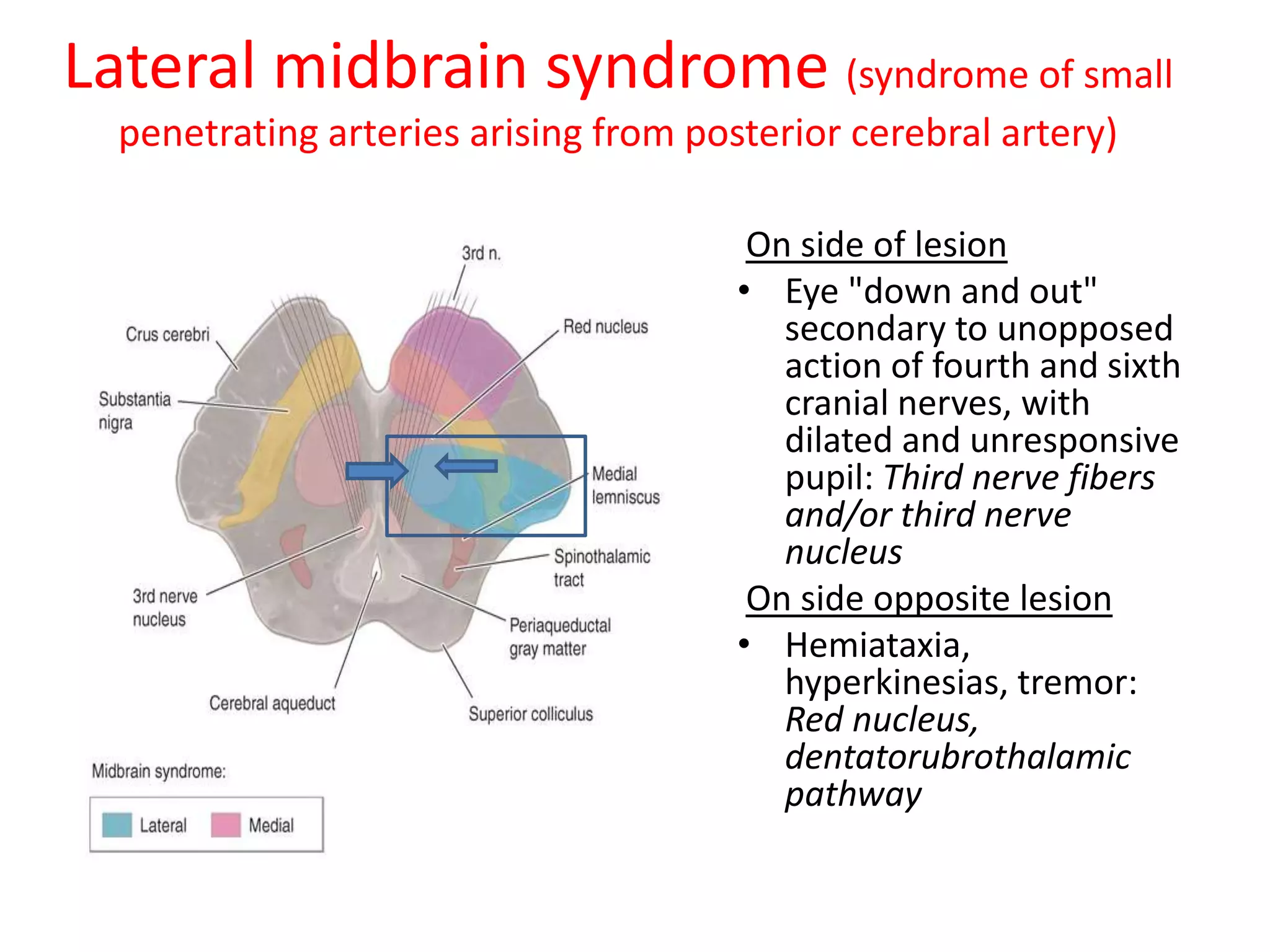 Lateral midbrain syndrome (syndrome of small
  penetrating arteries arising from posterior cerebral artery)

                                        On side of lesion
                                       • Eye "down and out"
                                          secondary to unopposed
                                          action of fourth and sixth
                                          cranial nerves, with
                                          dilated and unresponsive
                                          pupil: Third nerve fibers
                                          and/or third nerve
                                          nucleus
                                        On side opposite lesion
                                       • Hemiataxia,
                                          hyperkinesias, tremor:
                                          Red nucleus,
                                          dentatorubrothalamic
                                          pathway
 