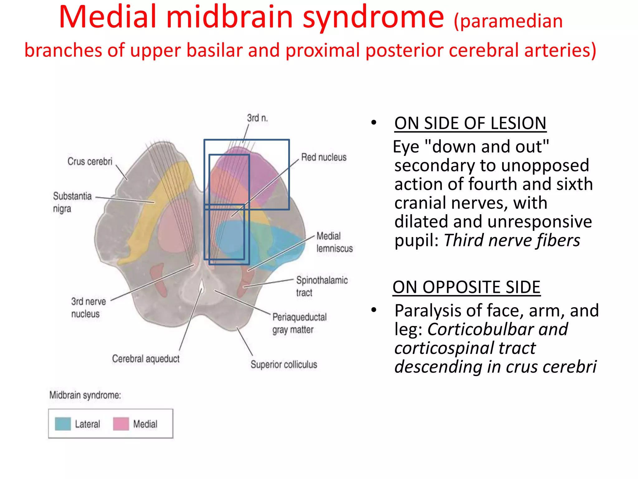 Medial midbrain syndrome (paramedian
branches of upper basilar and proximal posterior cerebral arteries)


                                        • ON SIDE OF LESION
                                          Eye "down and out"
                                          secondary to unopposed
                                          action of fourth and sixth
                                          cranial nerves, with
                                          dilated and unresponsive
                                          pupil: Third nerve fibers

                                          ON OPPOSITE SIDE
                                        • Paralysis of face, arm, and
                                          leg: Corticobulbar and
                                          corticospinal tract
                                          descending in crus cerebri
 