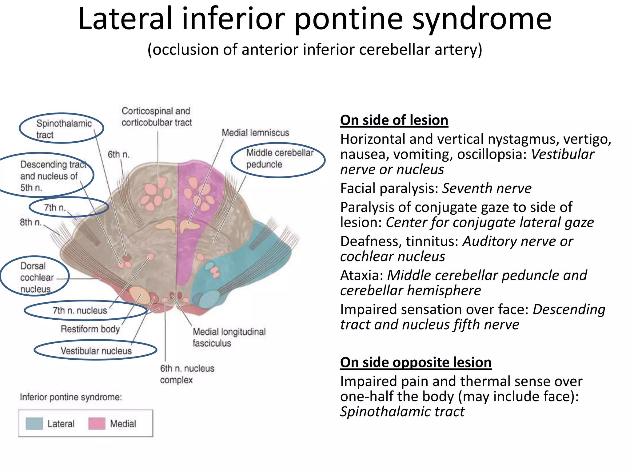Lateral inferior pontine syndrome
    (occlusion of anterior inferior cerebellar artery)


                             •   On side of lesion
                             •   Horizontal and vertical nystagmus, vertigo,
                                 nausea, vomiting, oscillopsia: Vestibular
                                 nerve or nucleus
                             •   Facial paralysis: Seventh nerve
                             •   Paralysis of conjugate gaze to side of
                                 lesion: Center for conjugate lateral gaze
                             •   Deafness, tinnitus: Auditory nerve or
                                 cochlear nucleus
                             •   Ataxia: Middle cerebellar peduncle and
                                 cerebellar hemisphere
                             •   Impaired sensation over face: Descending
                                 tract and nucleus fifth nerve

                             •   On side opposite lesion
                             •   Impaired pain and thermal sense over
                                 one-half the body (may include face):
                                 Spinothalamic tract
 