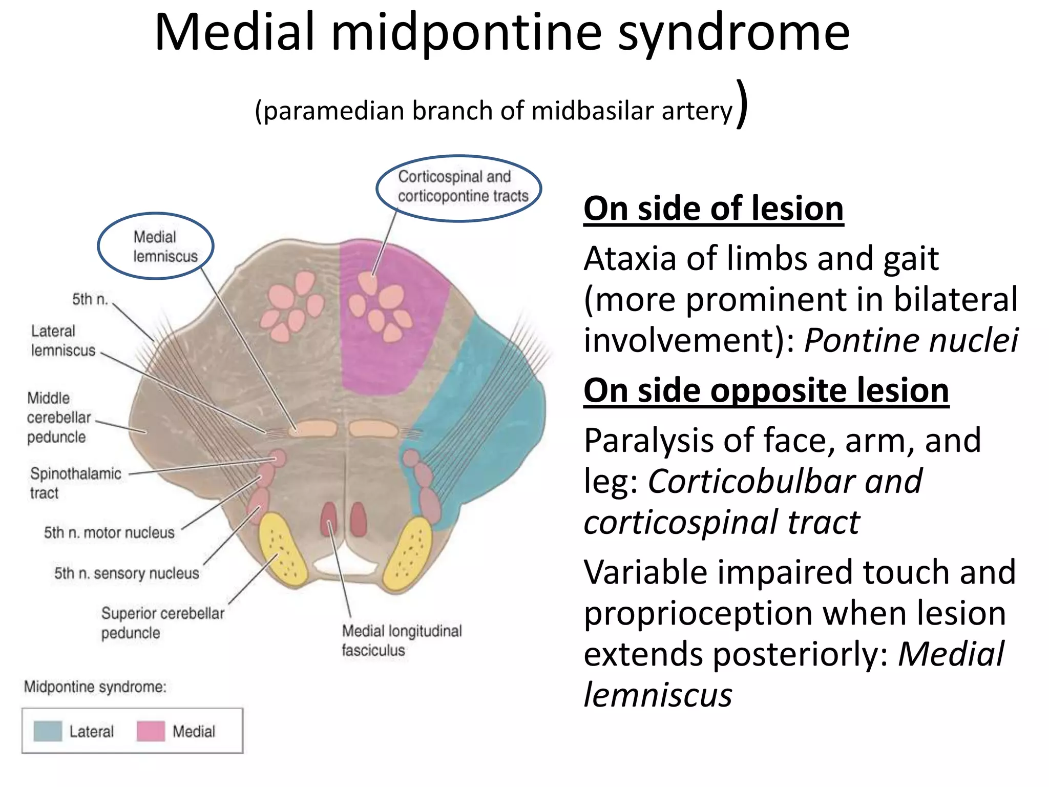 Medial midpontine syndrome
   (paramedian branch of midbasilar artery)


                        • On side of lesion
                        • Ataxia of limbs and gait
                          (more prominent in bilateral
                          involvement): Pontine nuclei
                        • On side opposite lesion
                        • Paralysis of face, arm, and
                          leg: Corticobulbar and
                          corticospinal tract
                        • Variable impaired touch and
                          proprioception when lesion
                          extends posteriorly: Medial
                          lemniscus
 
