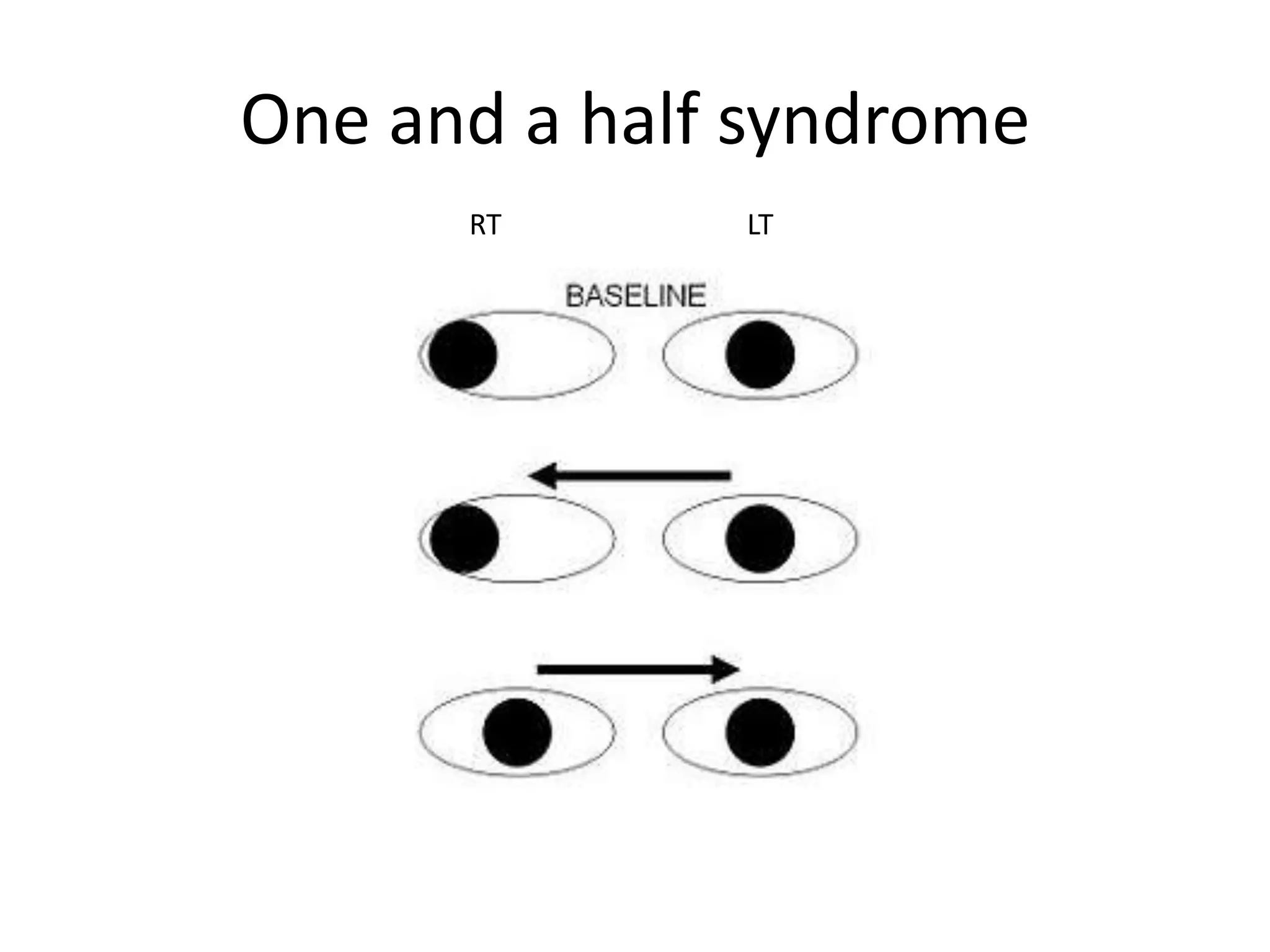One and a half syndrome
      RT      LT
 